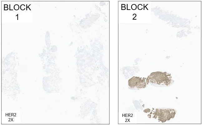 病例 1 两蜡块 HER2 IHC