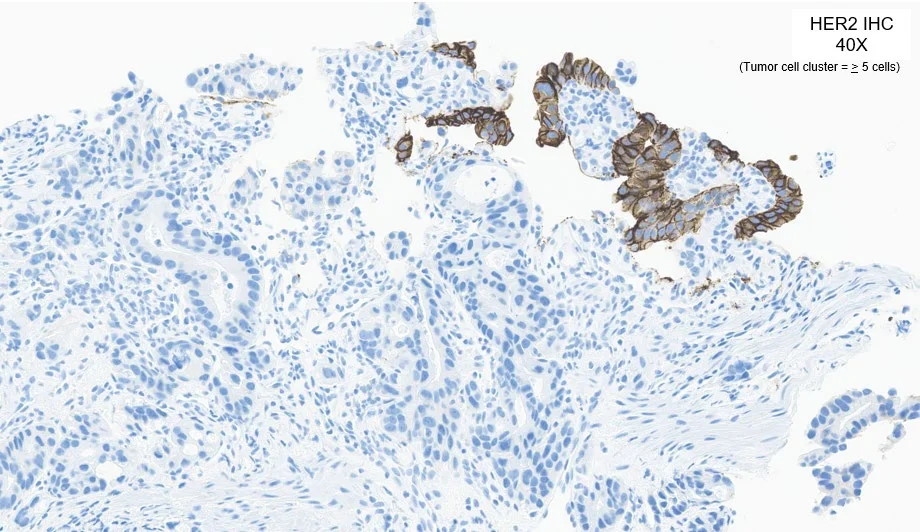 病例 2 HER2 IHC