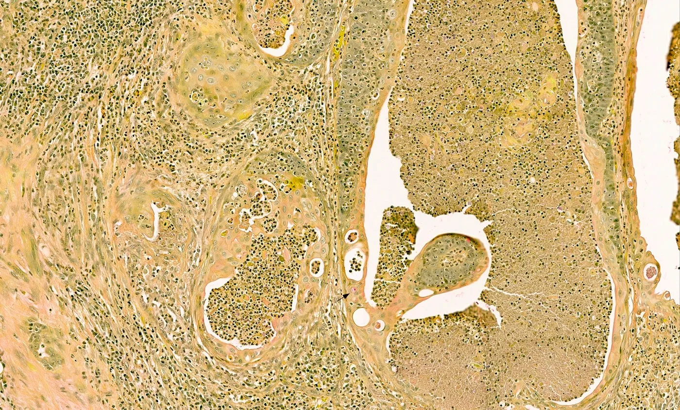 黏液卡红(Mucicarmine)