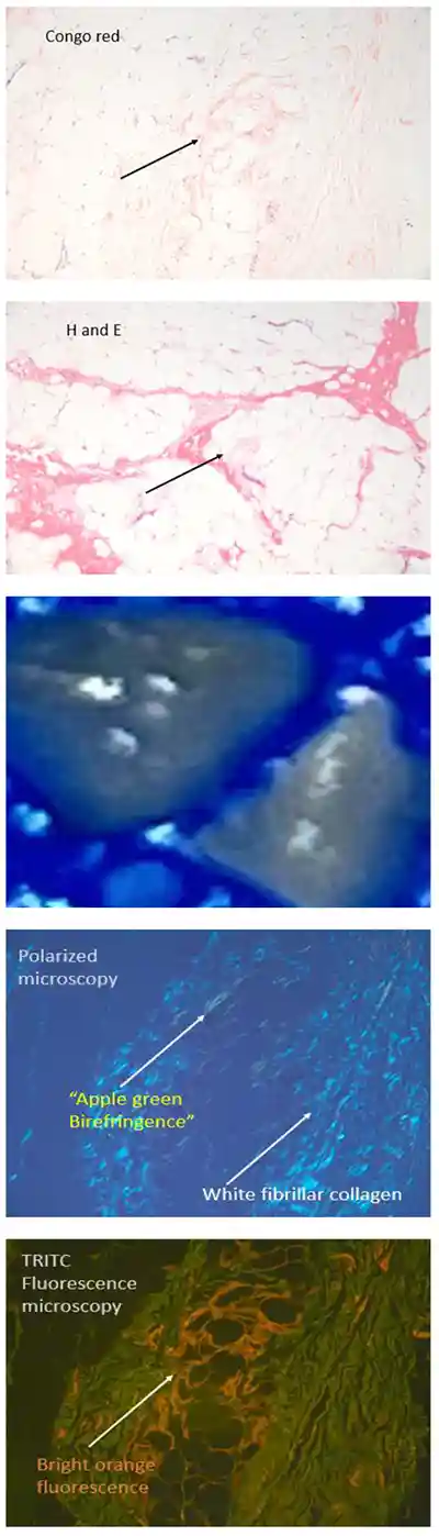图 12. 脂肪垫——局灶 Congo red,伴双折射与荧光