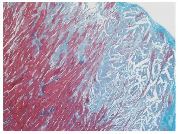图 8. 近观——trichrome 上蓝灰色淀粉样沉积