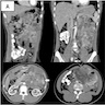 肠系膜肉瘤的 CT 扫描